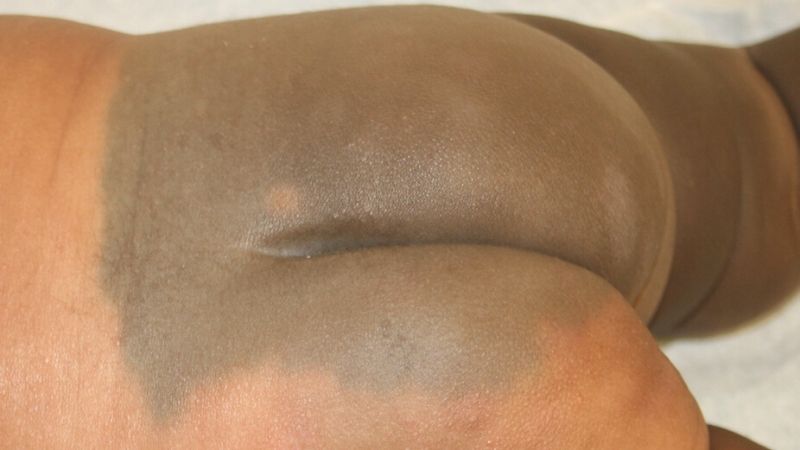 Đa phần các vết bớt này mọc ở khu vực mông và lưng bé