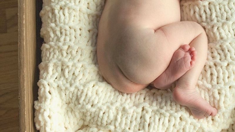 Vết chàm xanh ở trẻ sơ sinh là bệnh hắc tố da bẩm sinh